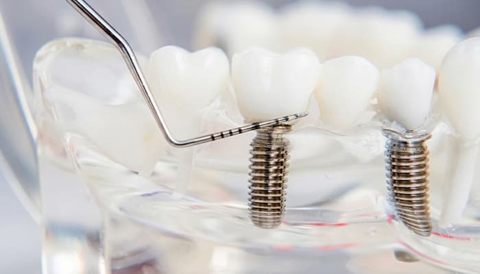 Implantes dentales